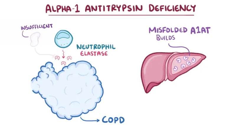 Hình 1: Vai trò của alpha-1-antitrypsin